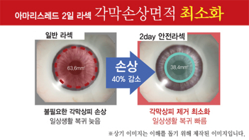아마리스레드 라식-라섹, 직업이나 눈 상태에 따라서 선택 방법 다양해져