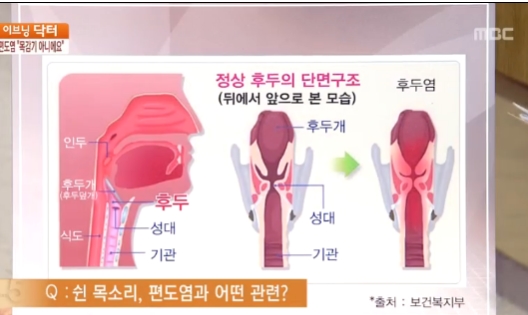 편도염에 좋은음식 / 사진=MBC