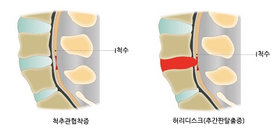 척추관협착증은 척추 내 척수(신경)를 근육, 인대, 뼈 등이 눌려 통증발생, 허리디스크는 추간판(디스크)가 탈출해서 척수를 눌러 통증이 발생함.