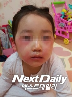 최근 정수기와 연수기 등 유료 관리서비스에 대해 소비자들의 불만이 급증하고 있다. 유료서비스를 받고 있는 연수기 관리 부실로 발생했을 것으로 추정되는 피부염 증상. 사진=넥스트데일리 독자 제공