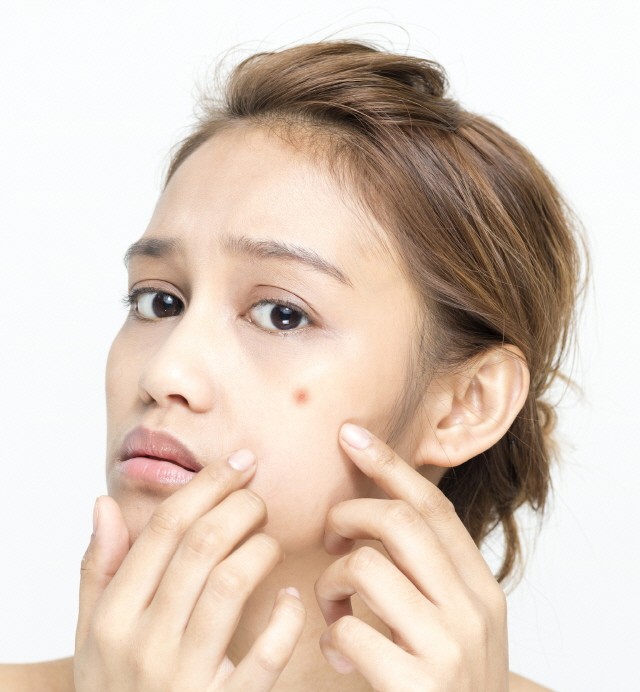 재발 잦은 여드름·여드름흉터치료, 여드름한의원 복합치료로 개선