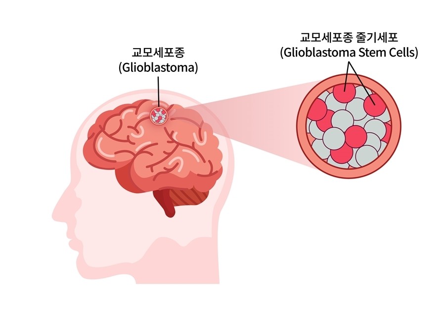 마크로젠은 교모세포종 암 줄기세포(그림 ‘빨간색 부분’)의 존재를 예측할 수 있는 다수의 새로운 바이오마커를 발굴했다. 이미지제공=마크로젠