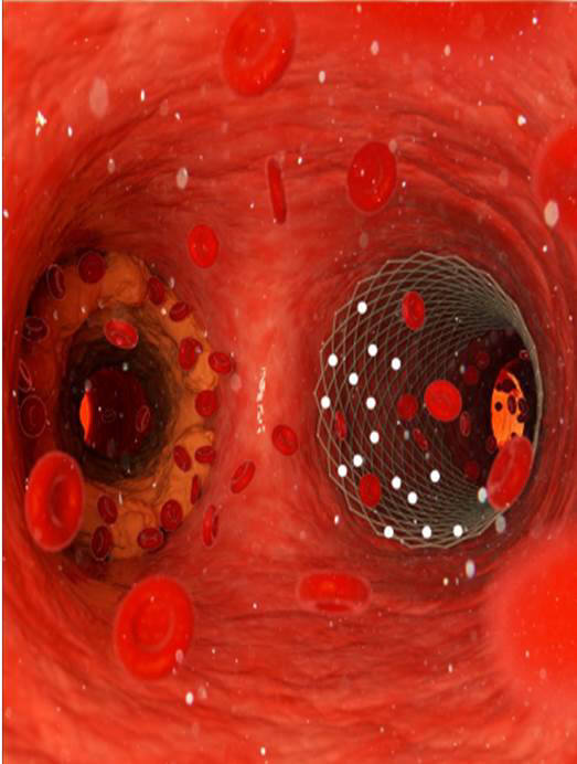 마이크로버블 방출 스마트 스텐트에 의해 혈액순환이 원활한 혈관