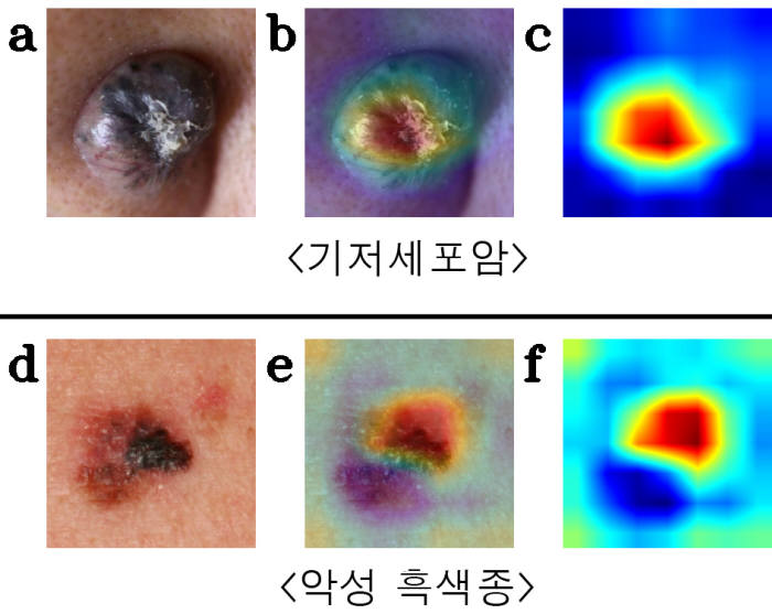 피부 종양 임상 및 인공지능 모델 인식 사진