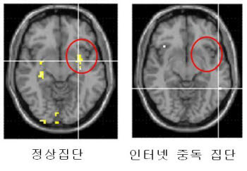 인터넷 중독 고위험군은 뇌기능 일부에 이상 증세가 나타난다. 정상인은 뇌 단면 원안(왼쪽)처럼 편도체가 활성화돼 있다.