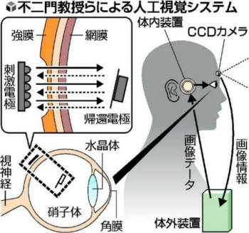 <표> 오사카대학 개발 전자 인공 망막 개념도강막, 망막, 자극전극, 귀환전극, 시신경, 수정체, 초자체, 각막, 체내장치, CCD카메라, 화상데이터, 화상정보, 체외장치(자료 오사카대학)