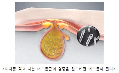 짜증나는 여드름, 2분 30초에 없어진다?