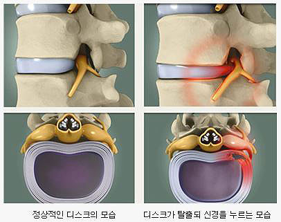 허리디스크 치료, 수술 없이도 가능하다?!