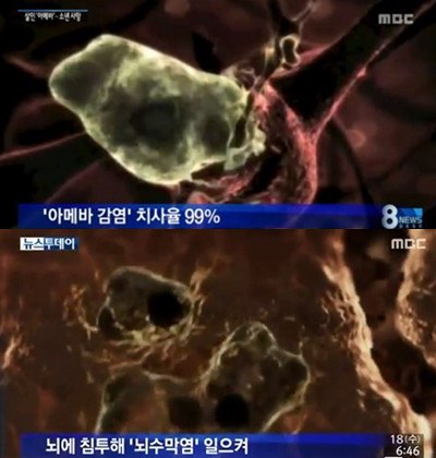 뇌 먹는 아메바 소녀 사망 치료법