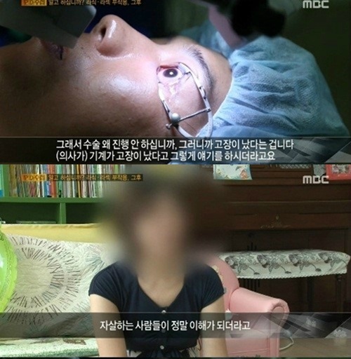 원추각막증 PD수첩 라식 라섹 부작용