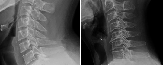 ▲ C자 모양의 정상적인 목<좌측>과 목뼈 전만 소실의 일자목<우측> 비교사진