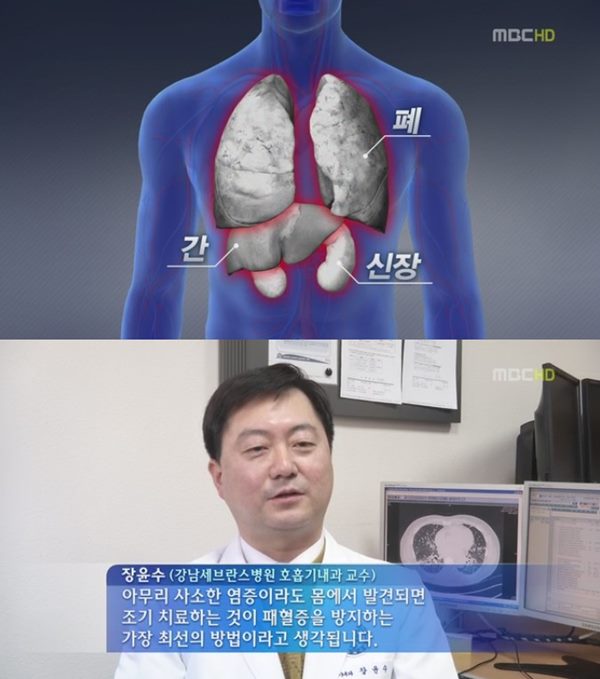 급성패혈증이란
 출처:/ MBC 뉴스 캡쳐