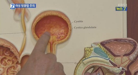 미주신경성 실신 예방법
 출처:/KBS1 화면 캡쳐