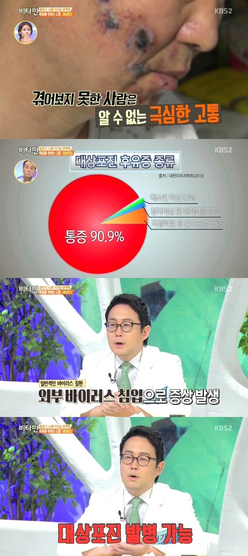 대상포진
 출처:/KBS