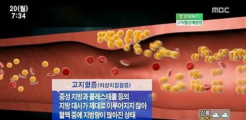 이상지질혈증이란
 출처:/MBC 화면 캡쳐