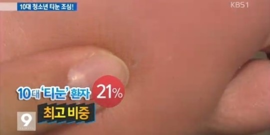 발바닥 굳은살 원인
 출처:/KBS1 화면 캡쳐