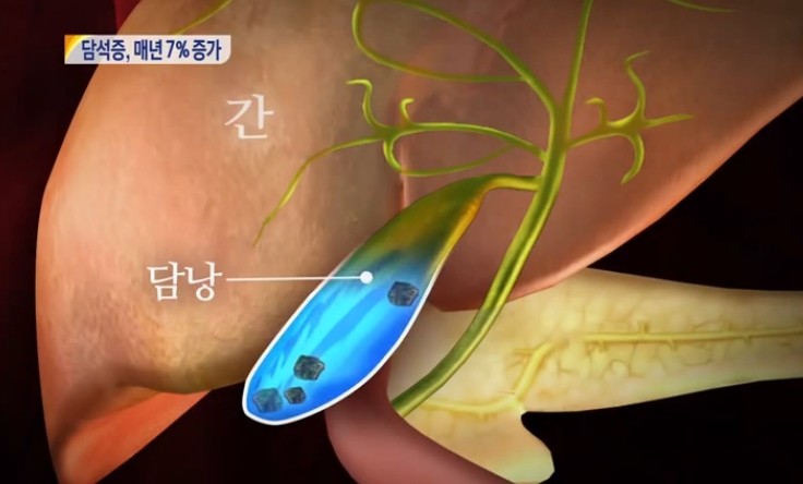 담석증 원인
 출처:/MBC뉴스 