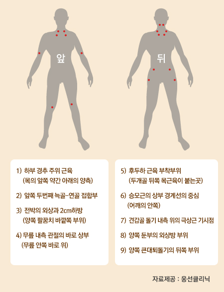 [홍성재 원장 의학칼럼] 만성섬유근육통(Fibromyalgia)