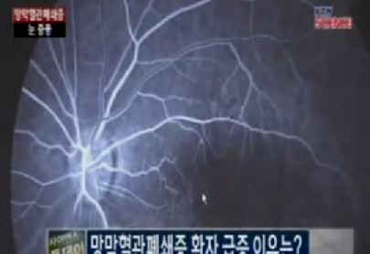 망막 혈관 폐쇄증
 출처:/ YTN 캡처