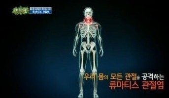 관절염에 좋은 운동
 출처:/ KBS2 '비타민' 캡처