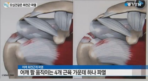 회전근개파열 원인
 출처:/ YTN 캡처