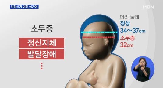 소두증 바이러스란
 출처:/ MBN 뉴스 캡쳐