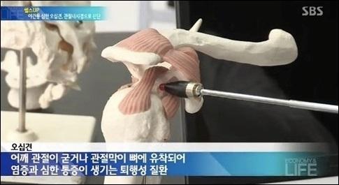 연관통 증상
 출처:/SBS 뉴스 캡처
 
 