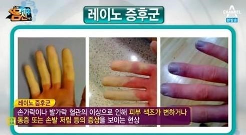 레이노증후군의 증상
 출처:/ 채널A 몸신 캡쳐