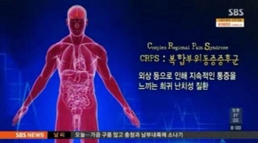 복합부위 통증증후군이란
 출처:/ SBS 뉴스 캡쳐