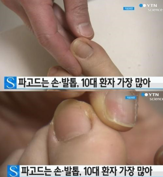 내향성 발톱 치료법
 출처:/ YTN science 캡쳐