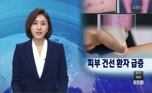 건선 환자 급증
 출처:/ KBS 뉴스 캡쳐