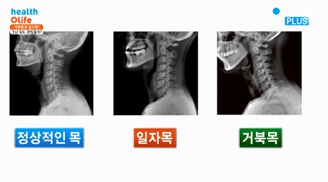 거북목 예방
 출처:/ YTN 캡처