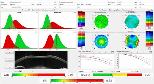 원추각막의 가능성을 찾아내는 각막생체역학검사(Corneal Biomechanics Exam.)