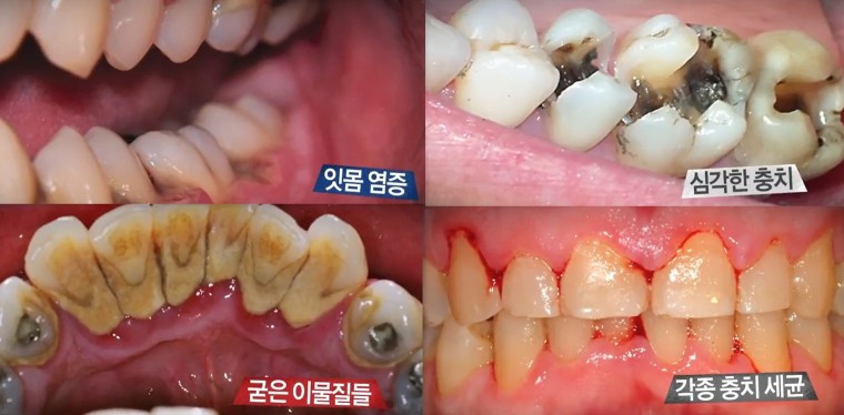 '시궁창' 입냄새 초간단 해결법 공개