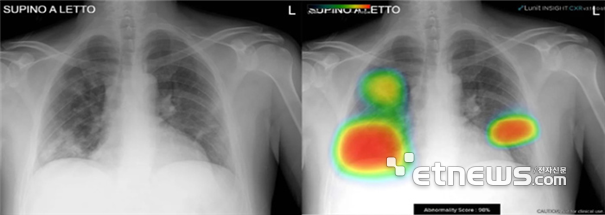 코로나19 확진자 폐 엑스레이(왼쪽), AI 소프트웨어 기반 폐경화 병변을 검출한 결과(오른쪽) 출처: 루닛(Lunit)