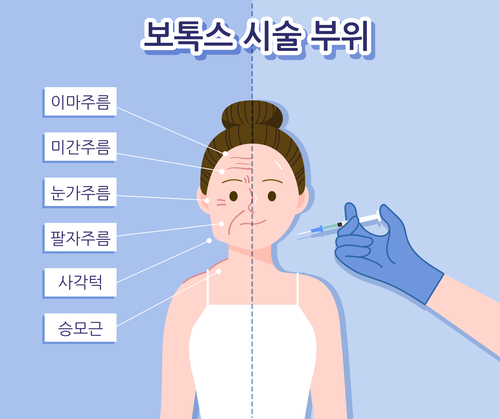 보톡스 (사진=게티이미지뱅크)