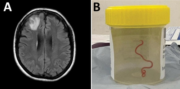 기생충에 감염된 호주 여성의 뇌 자기공명영상(MRI)와 수술을 통해 꺼낸 기생충. 사진=미국질병통제예방센터(CDC)