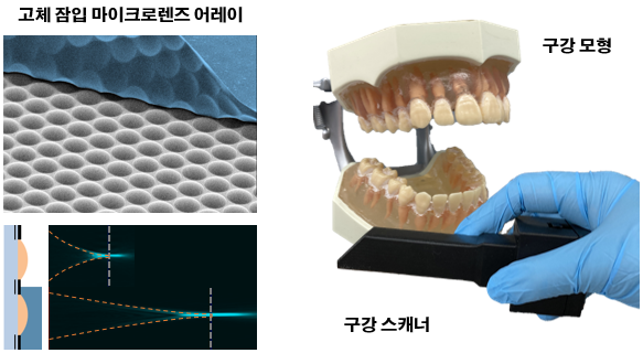 고체 잠입마이크로렌즈 어레이, 구강 스캐너와 구강 모형