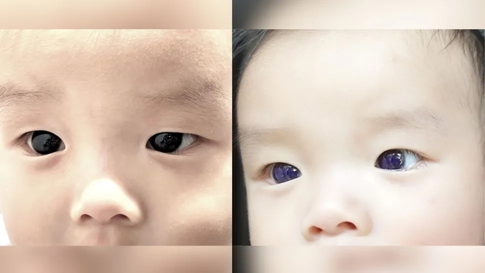태국의 생후 6개월된 남아가 항바이러스제를 투여받고 눈동자 색깔이 어두운 갈색(왼쪽)에서 남색으로 변했다. 사진=라이브사이언스/Jiravisitkul et al. 2023, DOI : 10.3389/fped.2023.1154814.