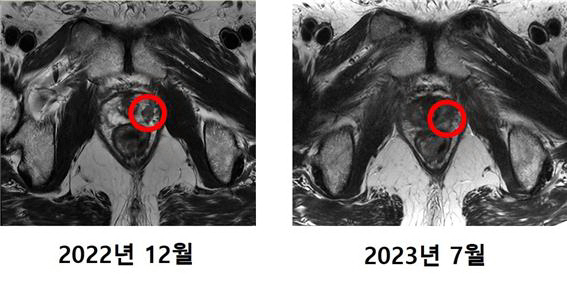 최씨의 MRI 촬영 사진. 기존에 발견됐던 암 조직(왼쪽)이 치료 후에는 발견되지 않았다. (사진=세브란스병원)