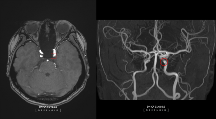 딥노이드의 AI 뇌동맥류 검출 진단보조 솔루션 '딥뉴로' (사진=딥노이드)
