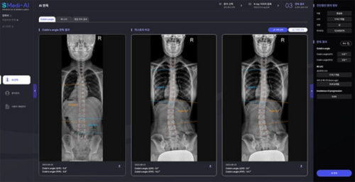 신라시스템이 개발한 메디-AI 시리즈의 척추측만증 진단 이미지