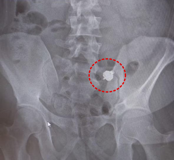 운전면허 필기 시험 중 부정행위가 발각돼 이어폰을 삼킨 남성의 엑스레이(X-ray) 사진. 사진=이탈리아 볼차노 경찰본부