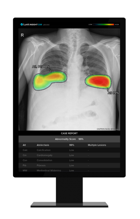 루닛 인사이트 CXR 트리아지