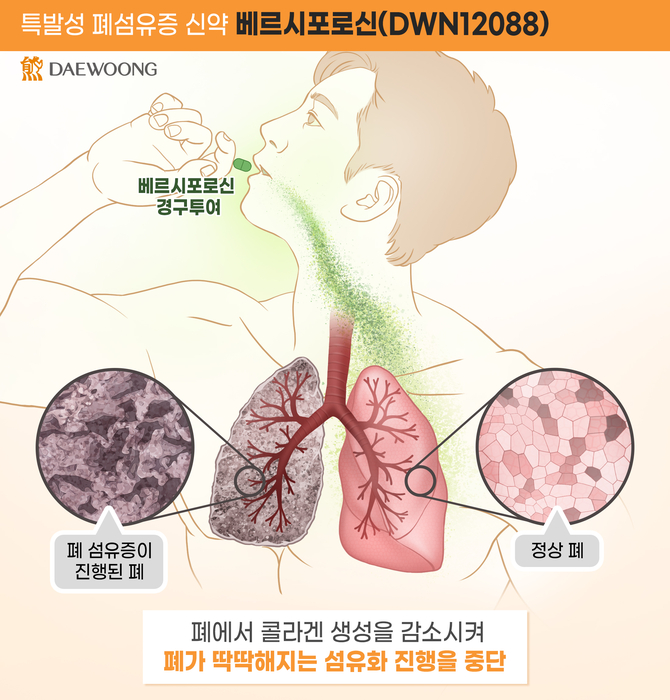 대웅제약 특발성 폐섬유증 신약 후보물질 '베르시포로신'