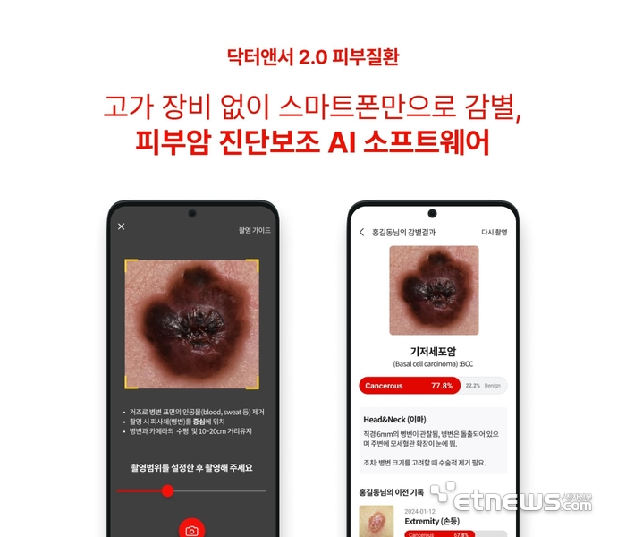 피부암 영상검출·진단보조 소프트웨어