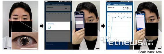 스마트 콘택트렌즈를 활용한 혈당 측정