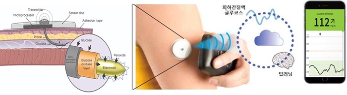무채혈 연속 혈당 측정 시스템 구조. 사진=엠비랩