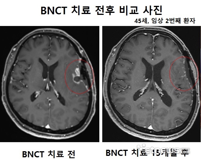 BNCT 치료 전후 비교 사진