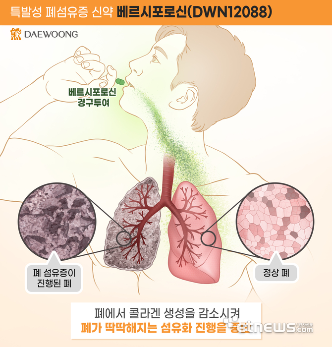 대웅제약 '베르시포로신'